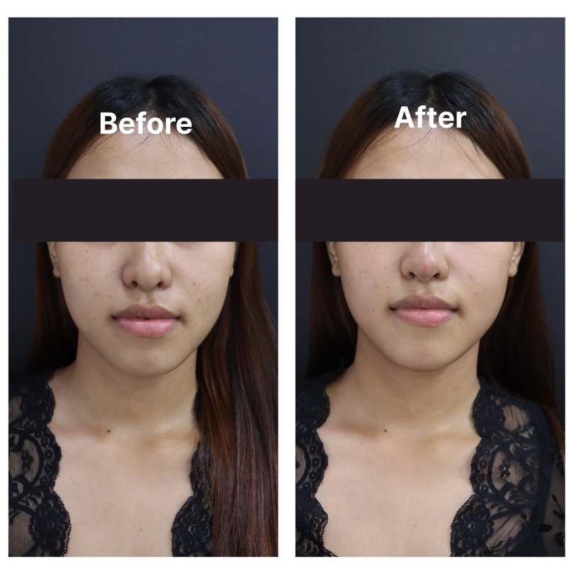 Lip Filler result KOQ10